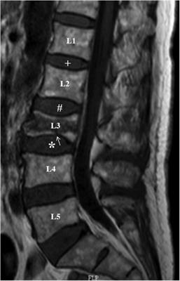 The role of endplate injury in intervertebral disc degeneration after vertebral augmentation in OVCF patients